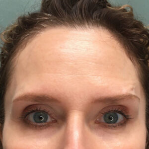 Close-up of a person's forehead and eyes, with a smooth, slightly reflective forehead suggests a botox treatment. The background is a muted blue-green color.