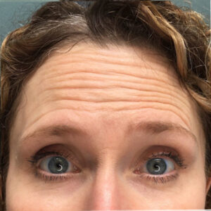 Close-up of a person with blue eyes raising up their eyebrows revealing a furrowed forehead with visible lines. The individual has wavy brown hair and wears subtle eye makeup.