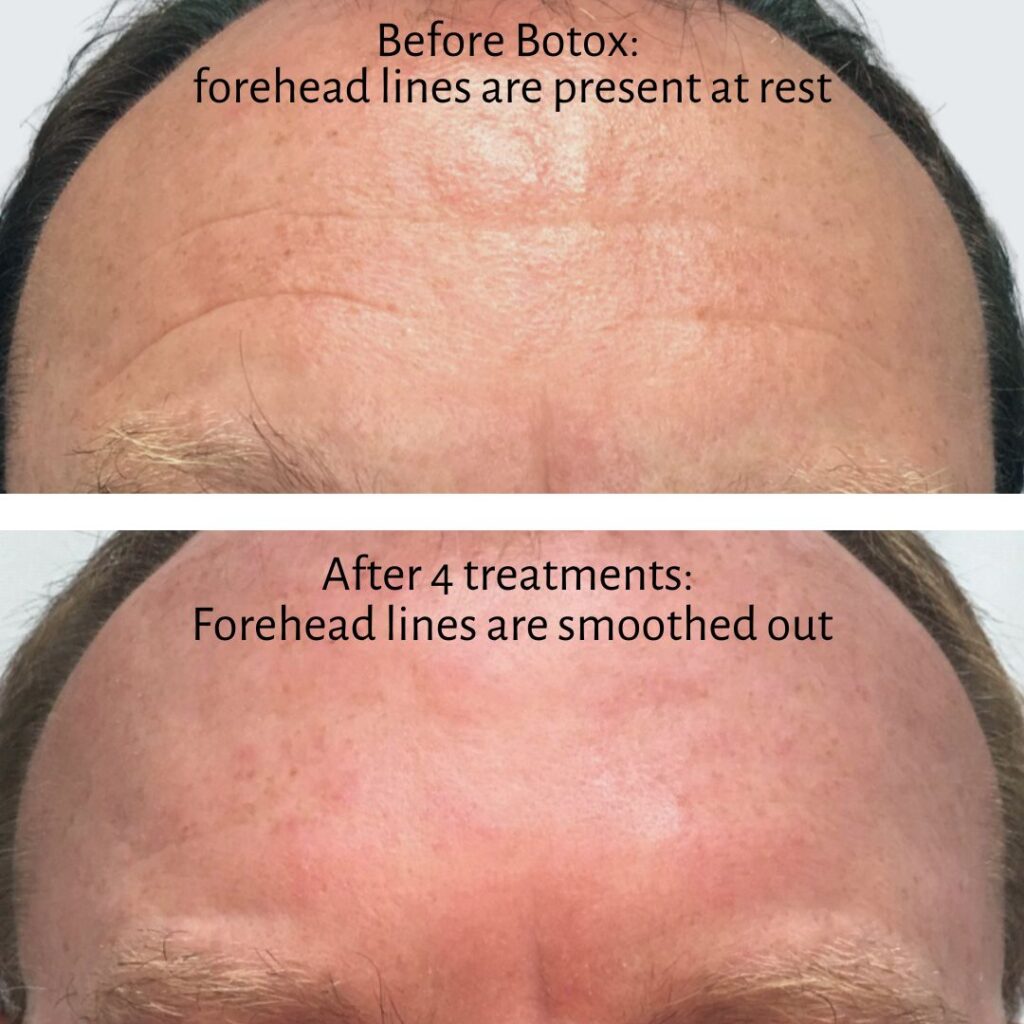 Can Botox treat deep forehead wrinkles? Yes! Here’s how. | Ageless ...