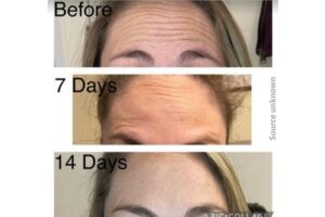 Three pictures of a woman's forehead showing what her forehead wrinkles look like before, mid-way, and at the end of a botox treatment.