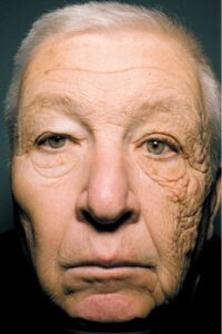 Elderly man's face depicting extensive sun damage, skin damage, and wrinkling on one side of his face, while the other side remains unharmed.