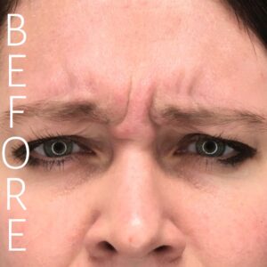 Close-up of a person's forehead and eyes, showing furrowed brows with visible lines. The word "BEFORE" is written vertically on the left side of the image.