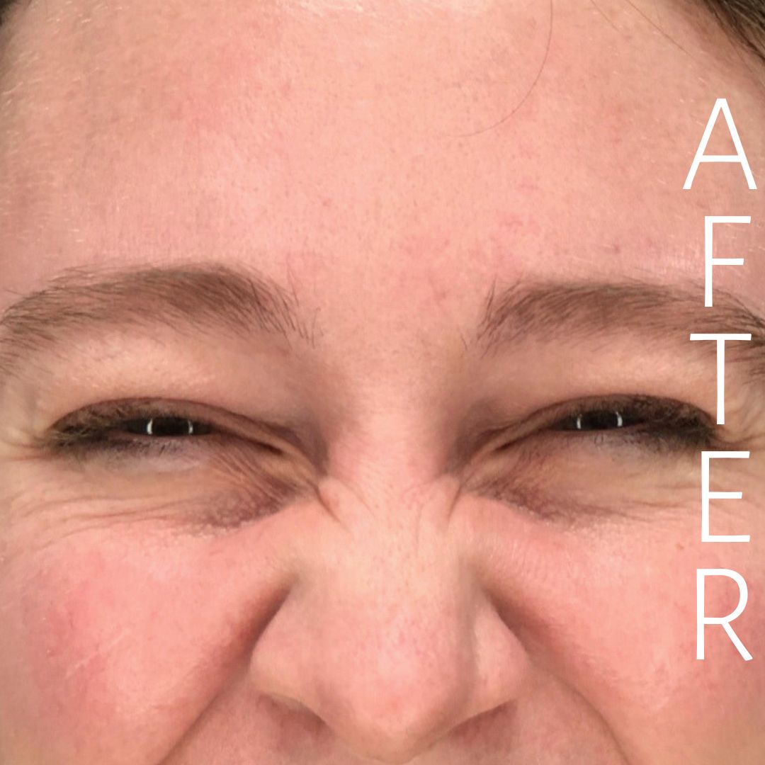 Close-up of a person's face with eyes closed, showing expression lines around the eyes. The word "AFTER" is written vertically on the right side of the image.