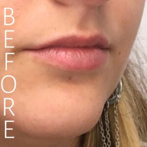 Close-up of a person's lips and chin, with text "BEFORE" on the left side. The lips are slightly parted and natural in appearance. The person is wearing chain earrings.