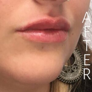 Close-up of a person's lips after a cosmetic treatment. The skin appears smooth and the lips are slightly glossy. There is a decorative earring visible, and the word "AFTER" is written vertically in white text on the right side.