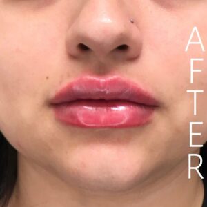 Close-up of a person's face showing freshly enhanced lips with a glossy finish. The word "AFTER" is vertically aligned on the right side, indicating a result of a cosmetic procedure.