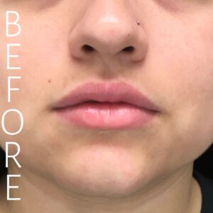 Close-up of a person's face showing their lips and part of their nose and cheeks. The word "BEFORE" is written vertically on the left side in white text. The person has a small nose piercing.